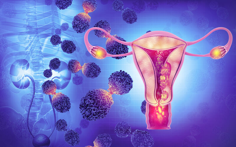 Female reproductive system diseases. Uterus cancer and endometrial malignant tumor as a uterine medical concept. 3d illustration