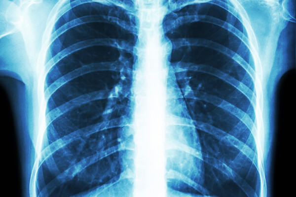 X-ray image of rib cage