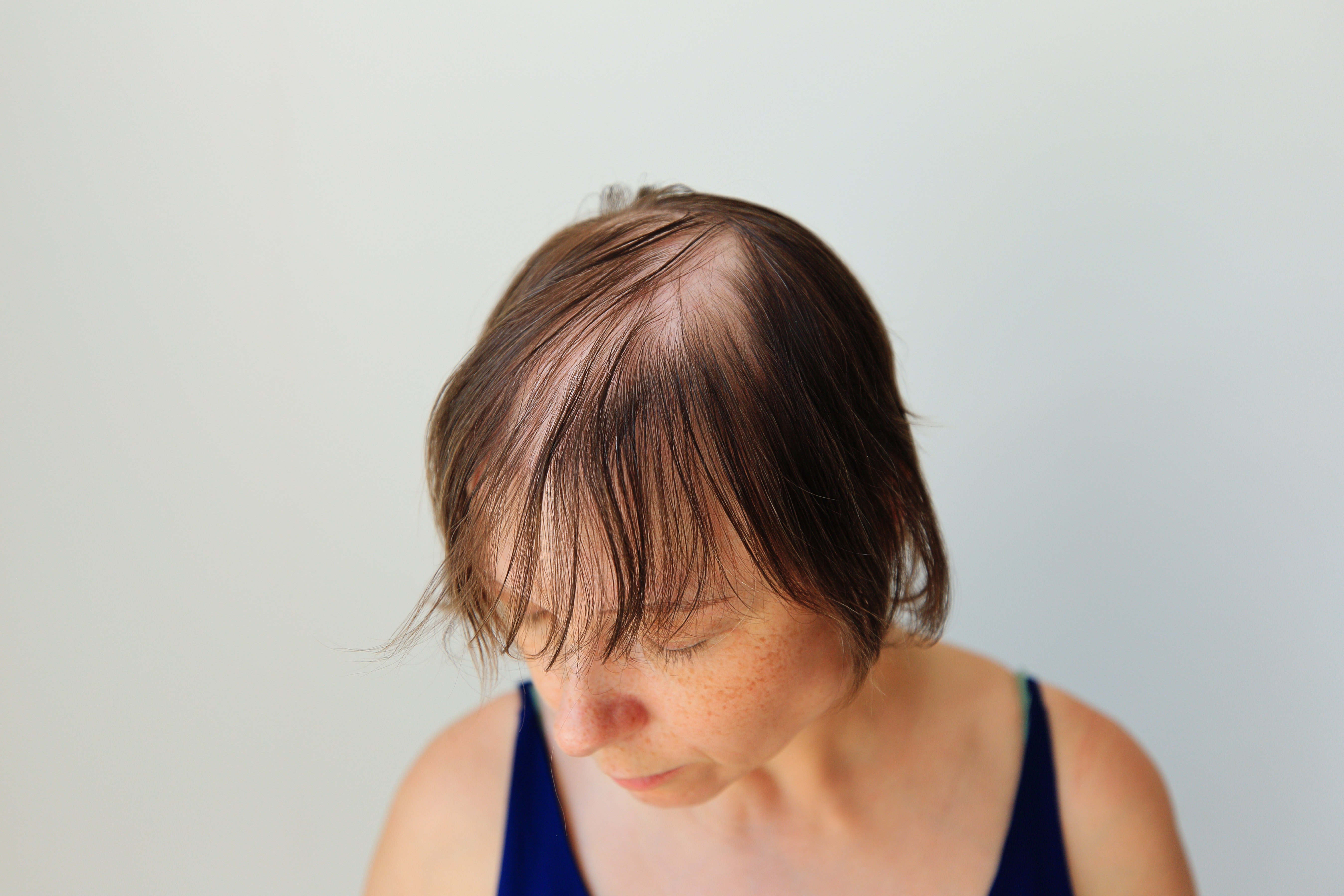 Alopecia areata, female patient_517057164.jpeg
