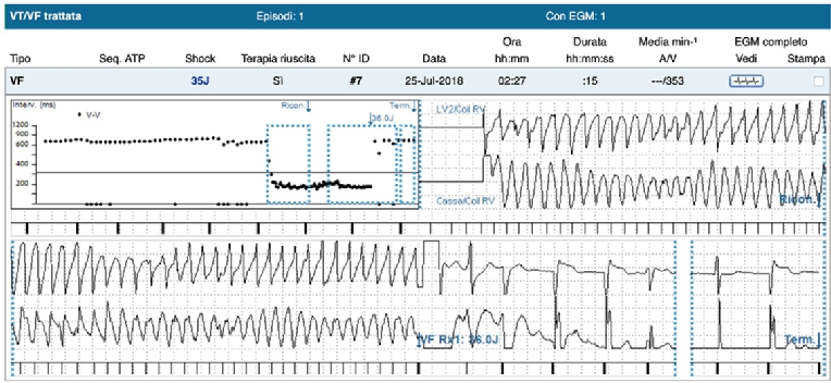 175_Galli_figure 1_The implantable cardioverter defibrillator beyond clinical practice.jpg