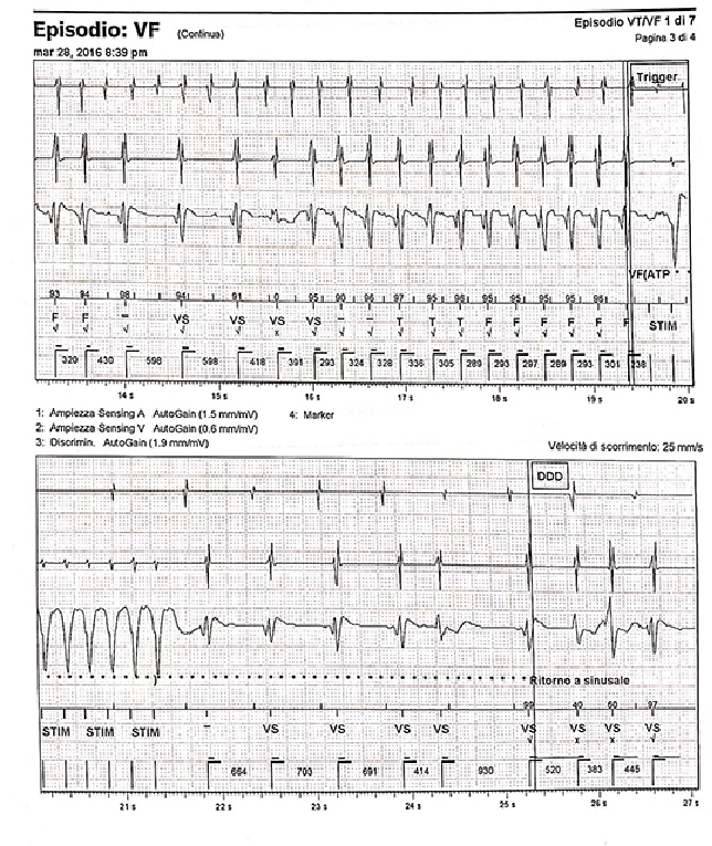 175_Galli_figure 2_The implantable cardioverter defibrillator beyond clinical practice.jpg