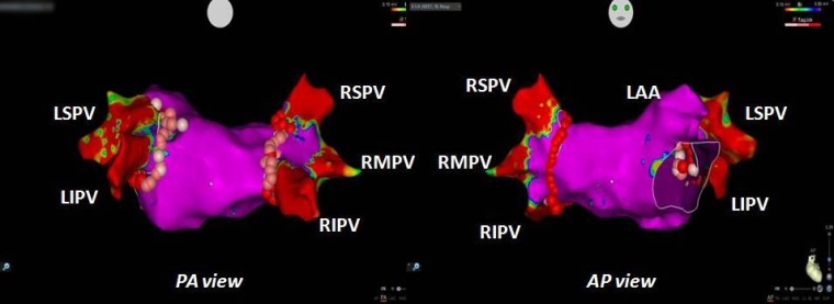 280_Koulouris_Figure 1_Catheter ablation for the management of atrial fibrillation.jpg