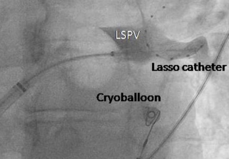 280_Koulouris_Figure 2_Catheter ablation for the management of atrial fibrillation.jpg