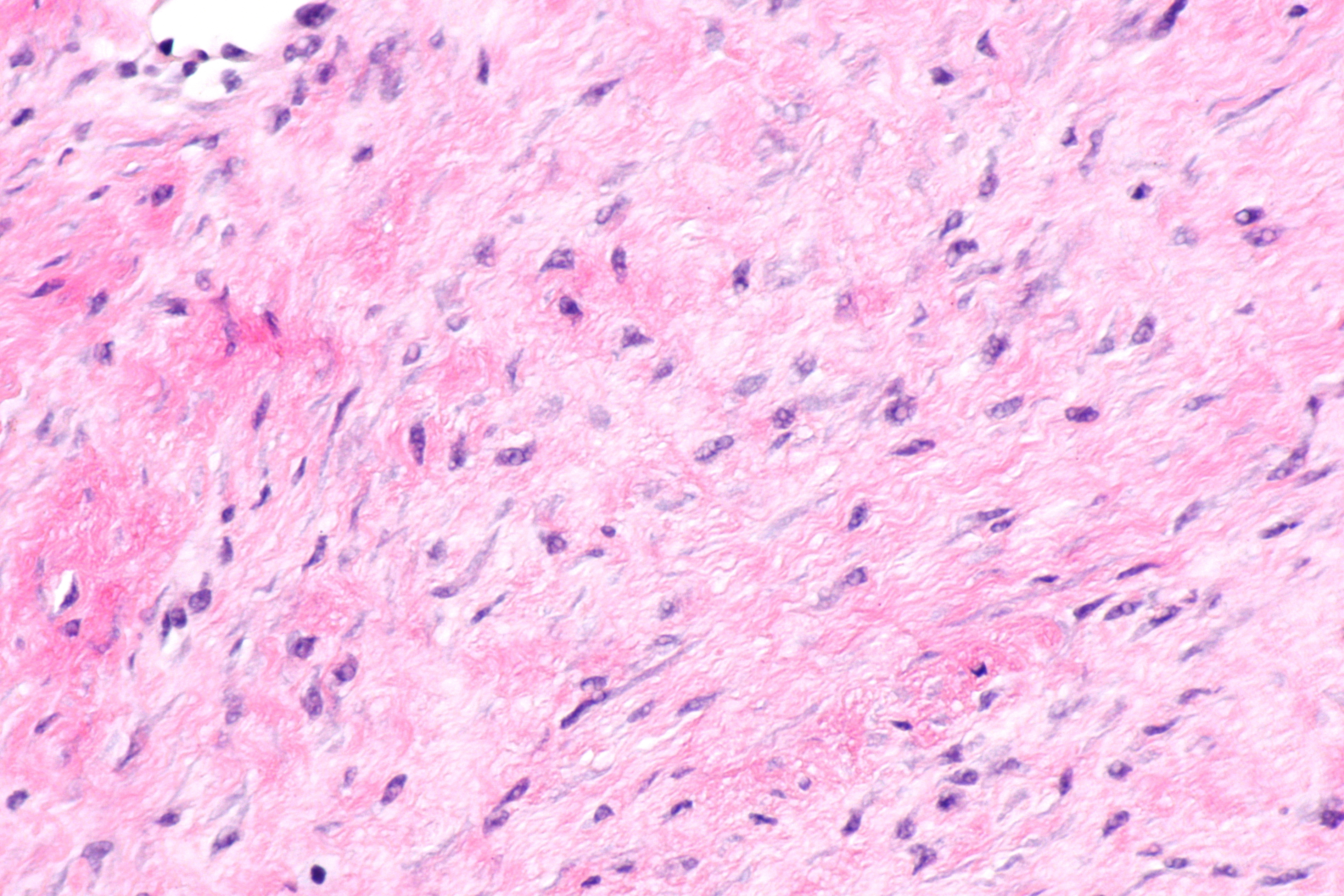 Histologic section of desmoid tumor tissue with spindle cells in fibrous connective tissue.