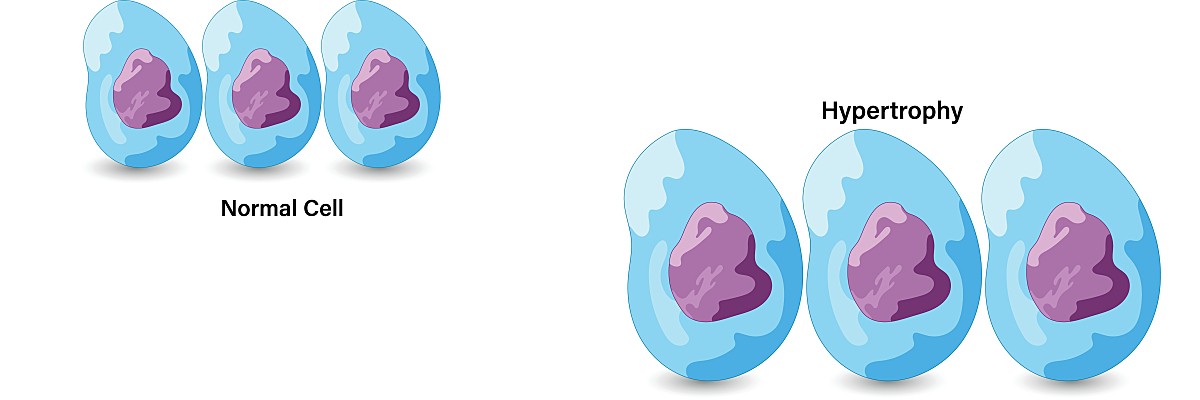 Left ventricular hypertrophy develops when the myocardial cells experience growth, or hypertrophy, resulting in structural changes in the heart. Diabetes and hypertension can both worsen the condition.