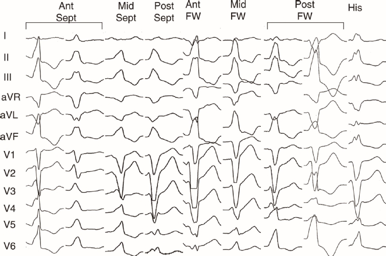 182_Ibarrola_Figure 1_Ventricular extrasystoles in athletes.jpg