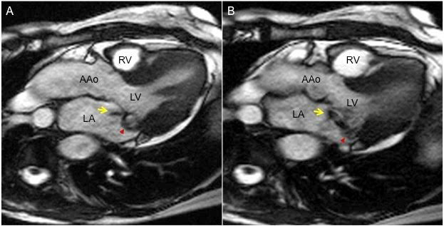 138_LaRocca_Figure 2-Mitral regurgitation a rapidly growing epidemic.jpg