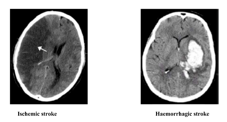 165_Abumuaileq_Figure 1_Atrial fibrillation in the old very old.jpg
