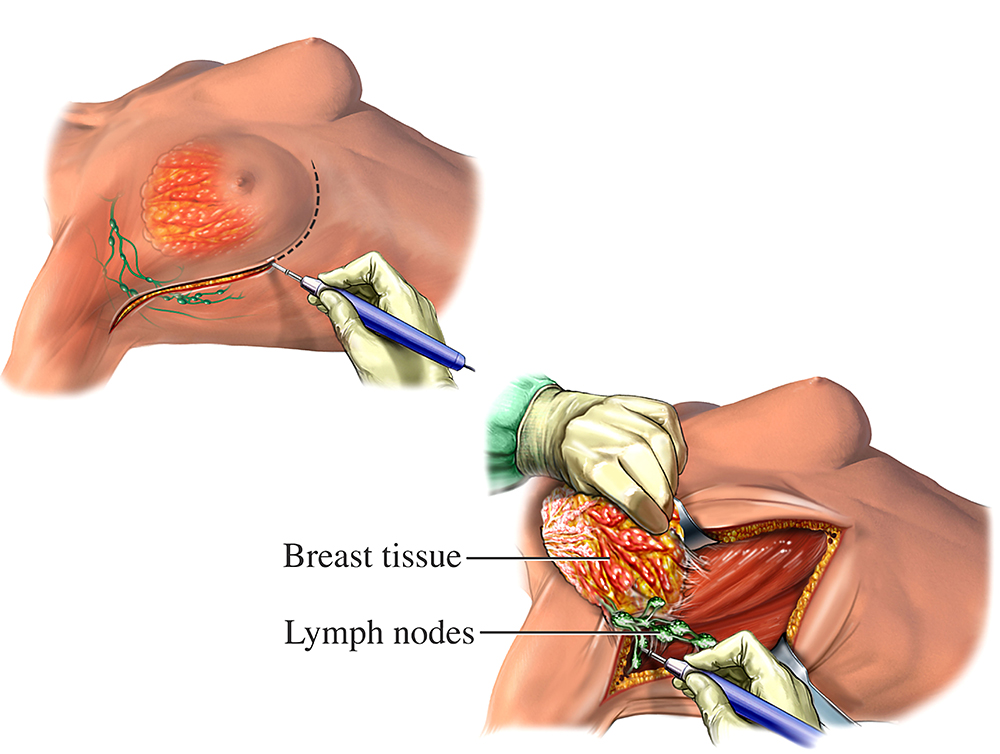An illustration showing a cut around the breast, showing the breast tissue and lymph nodes.