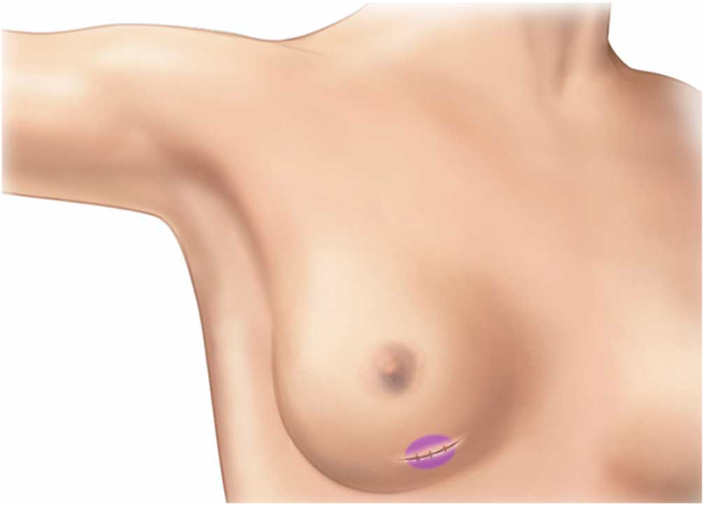 A right breast with a cut on the underside where an excision biopsy was
performed.