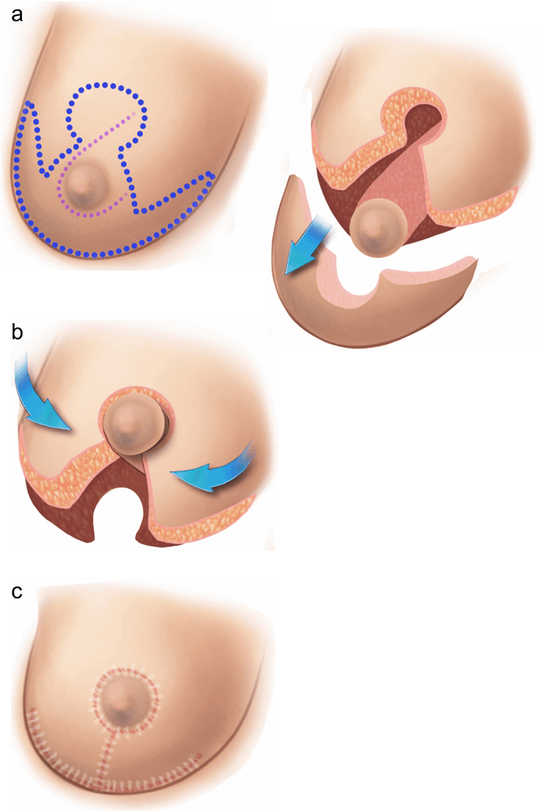 Illustration of what happens during a breast reduction procedure.