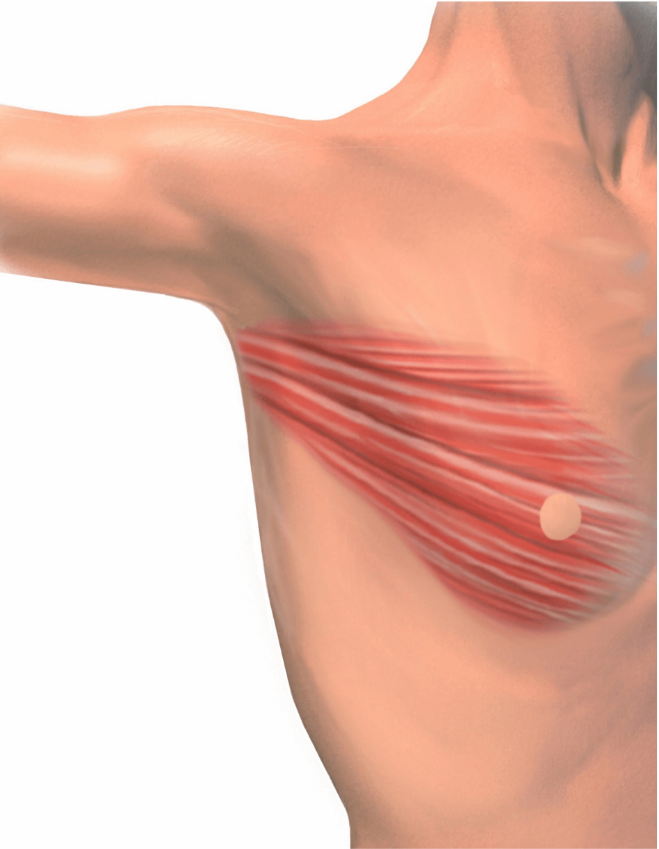 Illustration showing the latissimus dorsi muscle used for breast reconstruction.