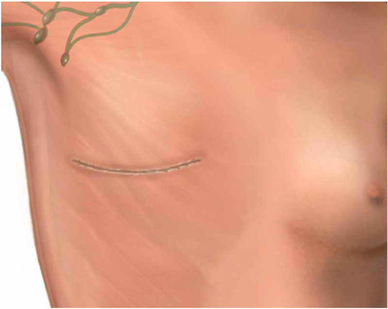 Illustration of a scar on the chest after a mastectomy.