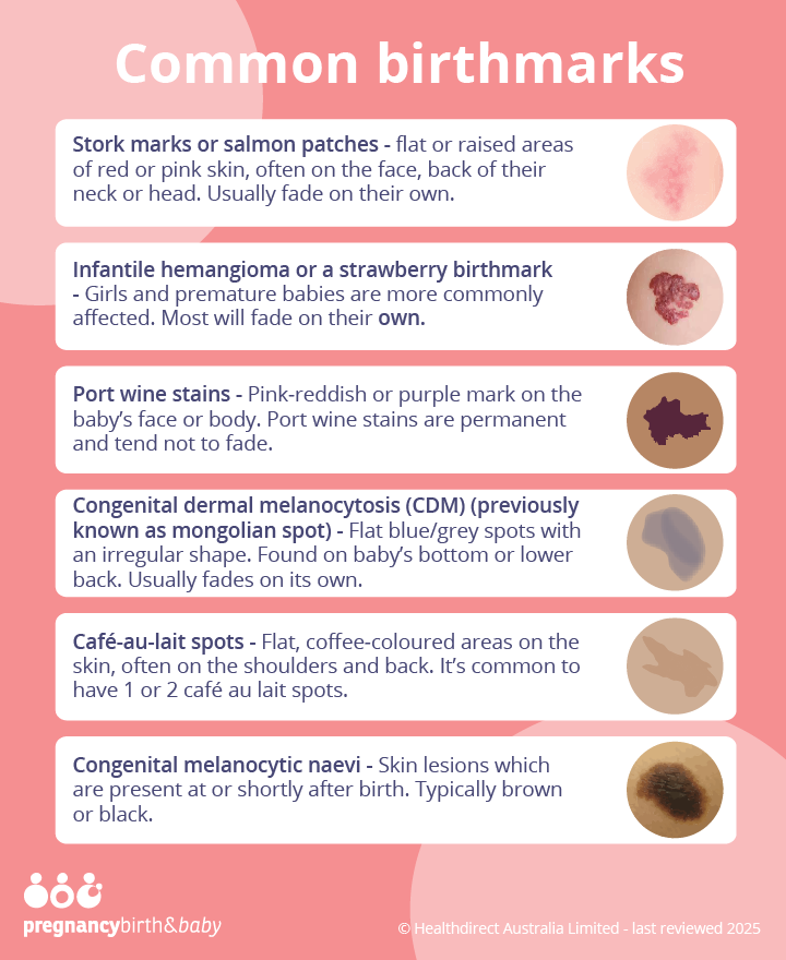 Illustration showing common birthmarks: Stork marks, Infantile haemangioma, Port wine stains, Mongolian spots, Café-au-lait spots and Congenital melanocytic naevi.