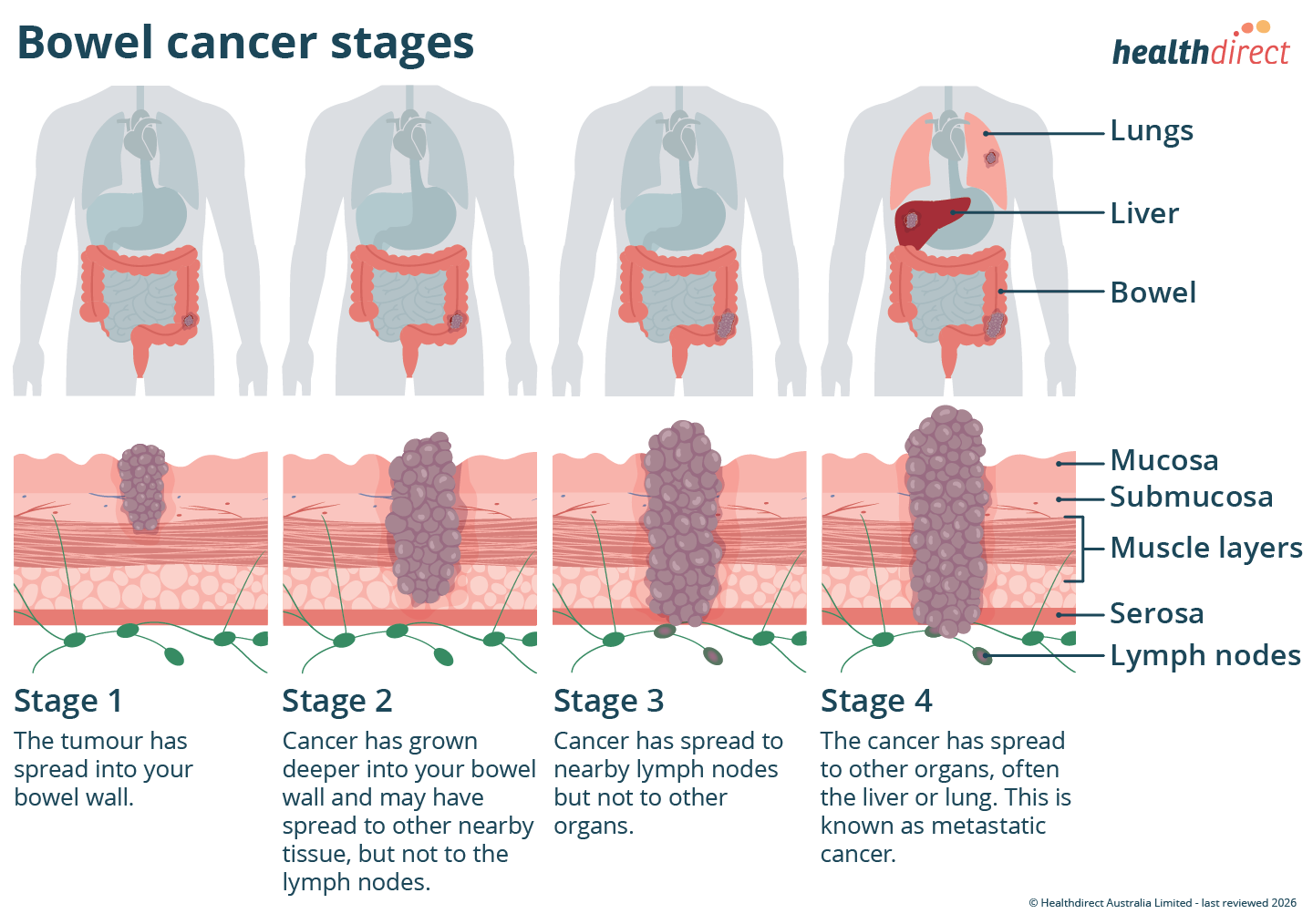 Four-part illustration of bowel cancer stages 1 to 4. Each stage shows the body with the bowel highlighted, and a cross-section of the bowel wall with the tumour growing progressively deeper. In stage 4, the cancer has also spread to the liver and lungs.