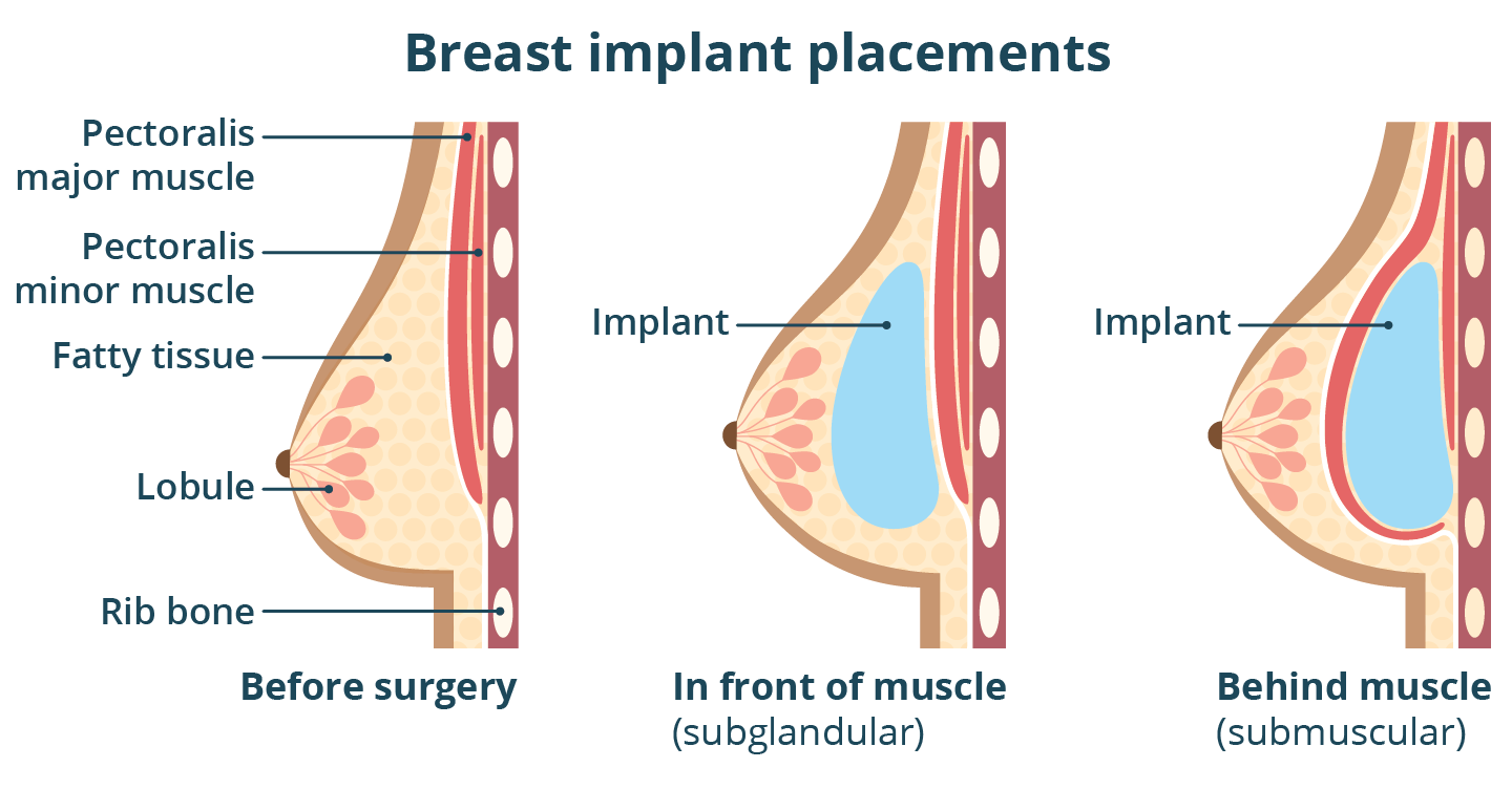 Placement options for breast implants. The image shows the breast before surgery, with implant in front of muscle and implant behind muscle. It also illustrates the chest wall muscle, ribs and fat cells of breast.