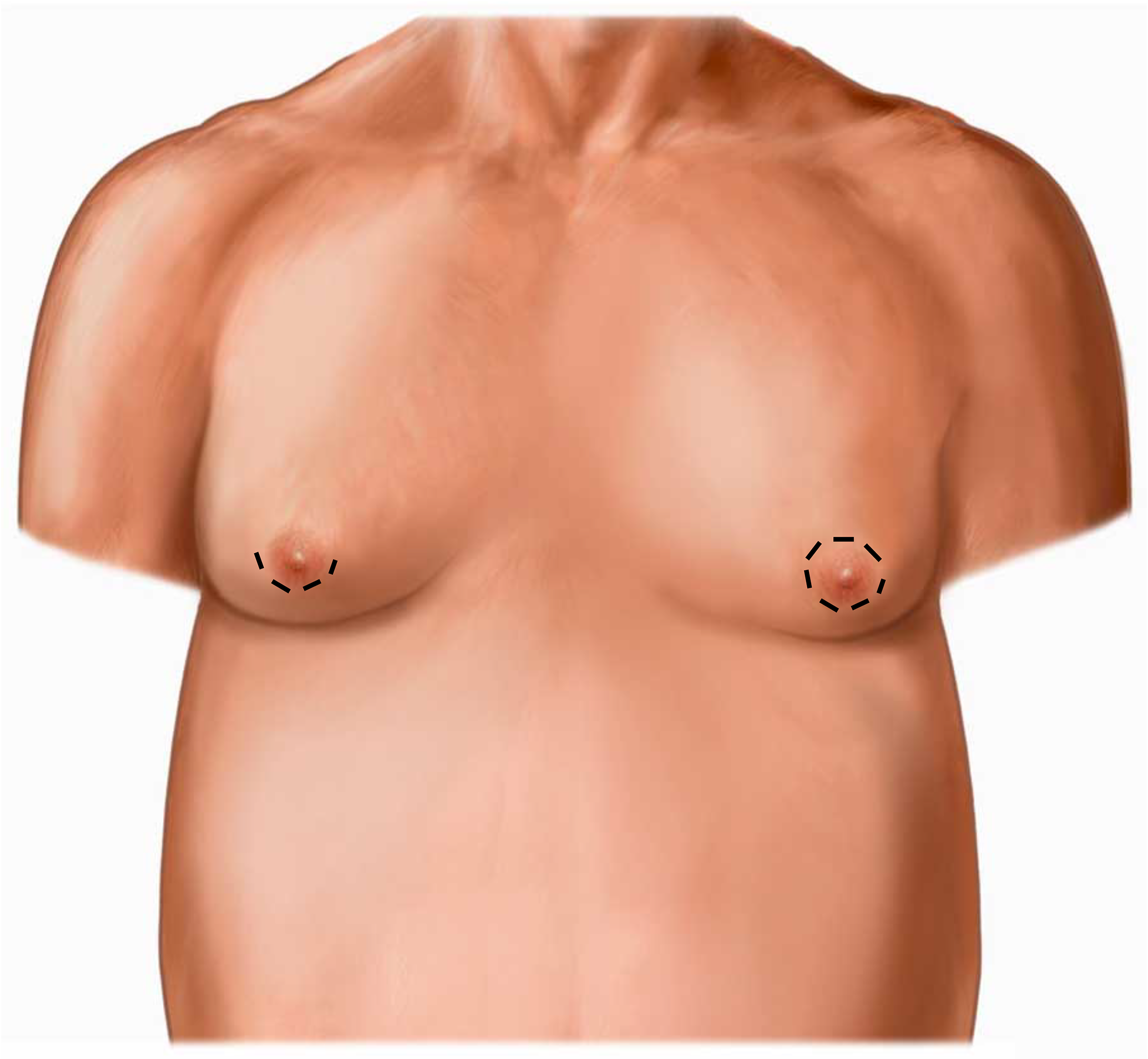 Illustration showing position of cuts for gynaecomastia surgery.