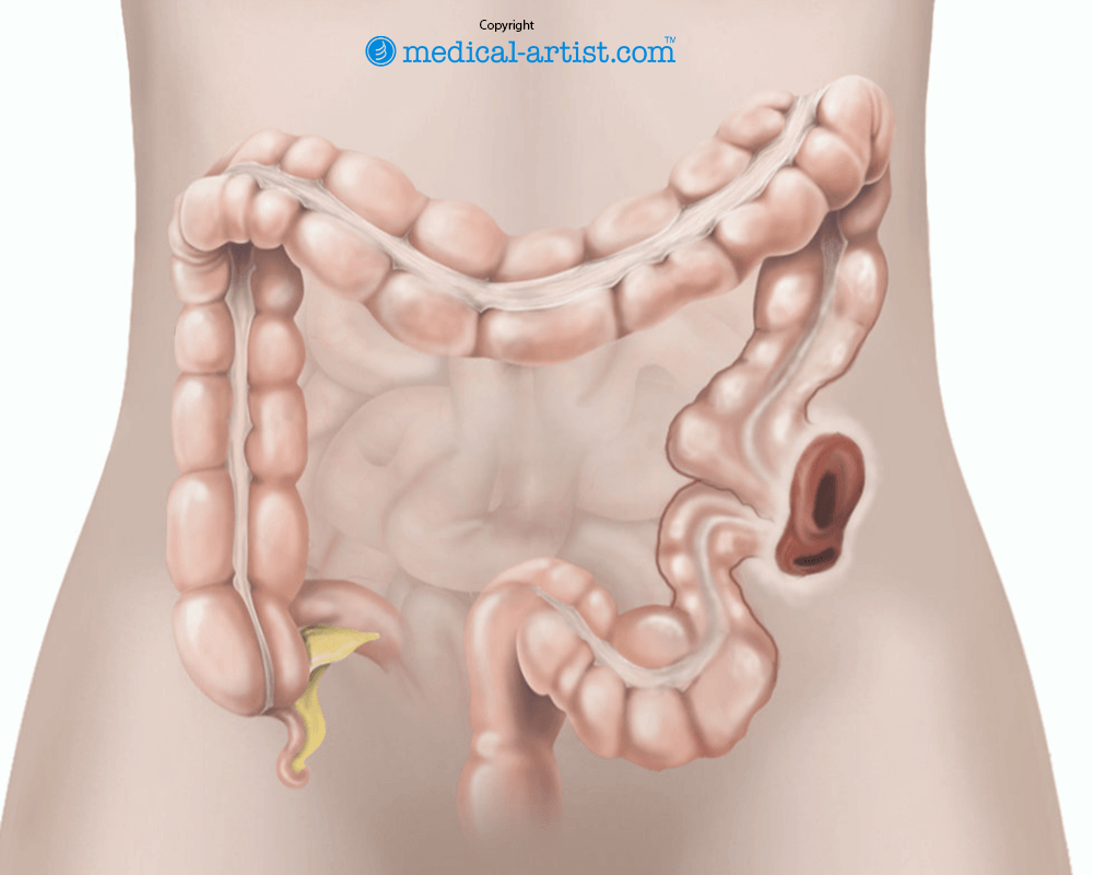 Illustration showing a loop colostomy