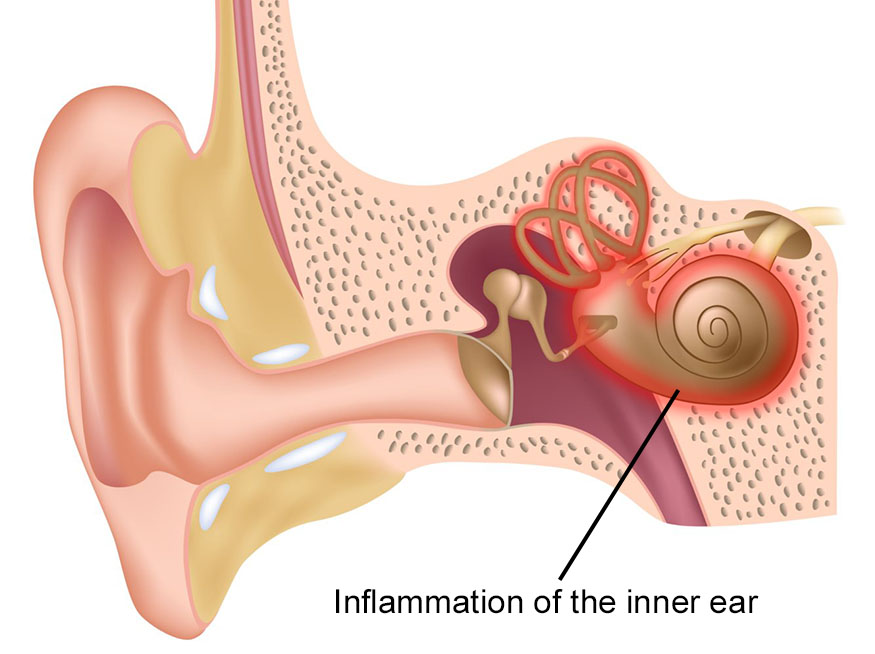 Illustration showing inflammation of the inner ear (labyrinthitis).