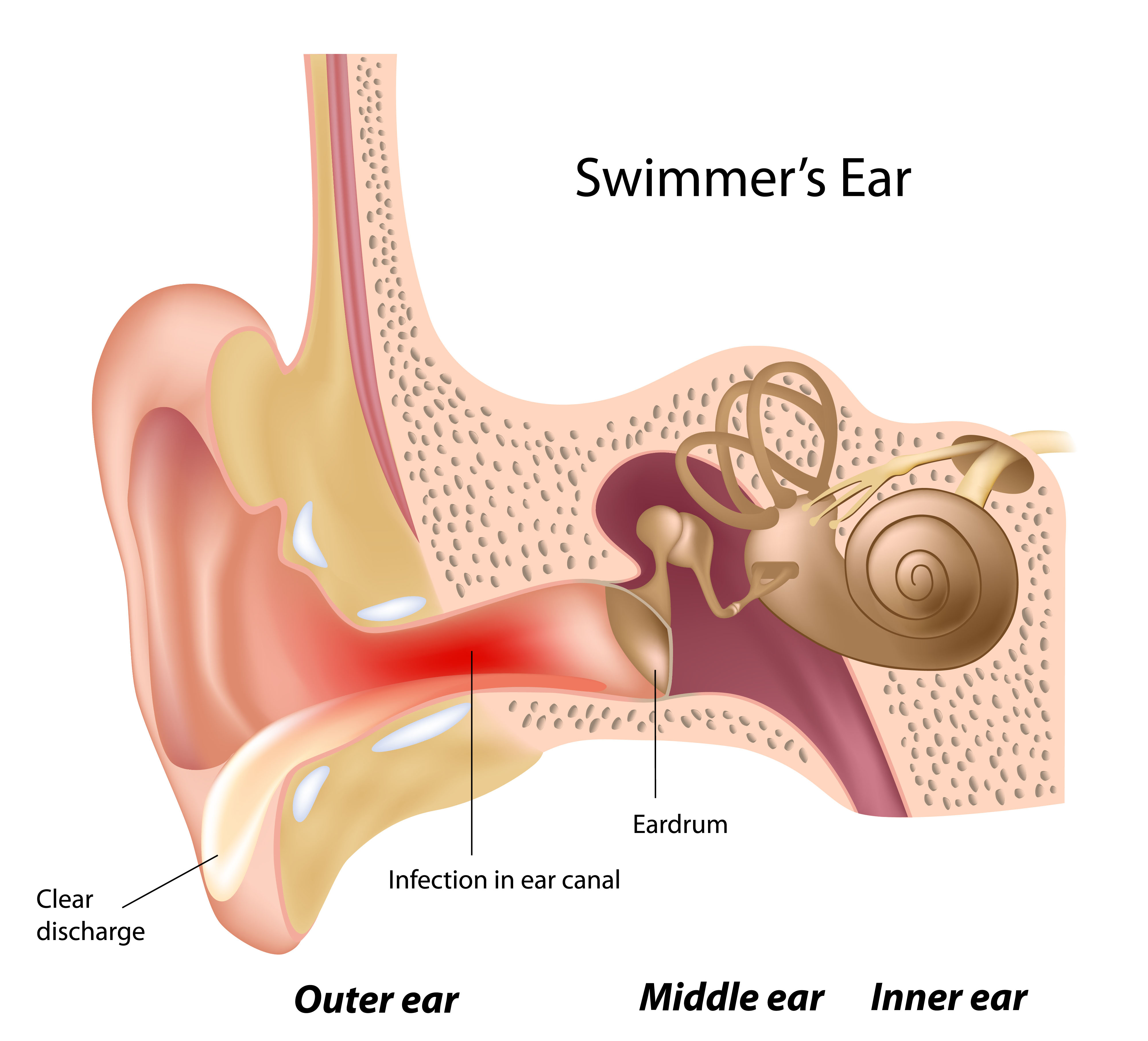 medical illustration of swimmer's ear