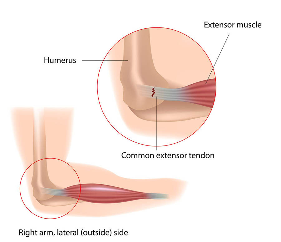 Illustration showing tennis elbow.