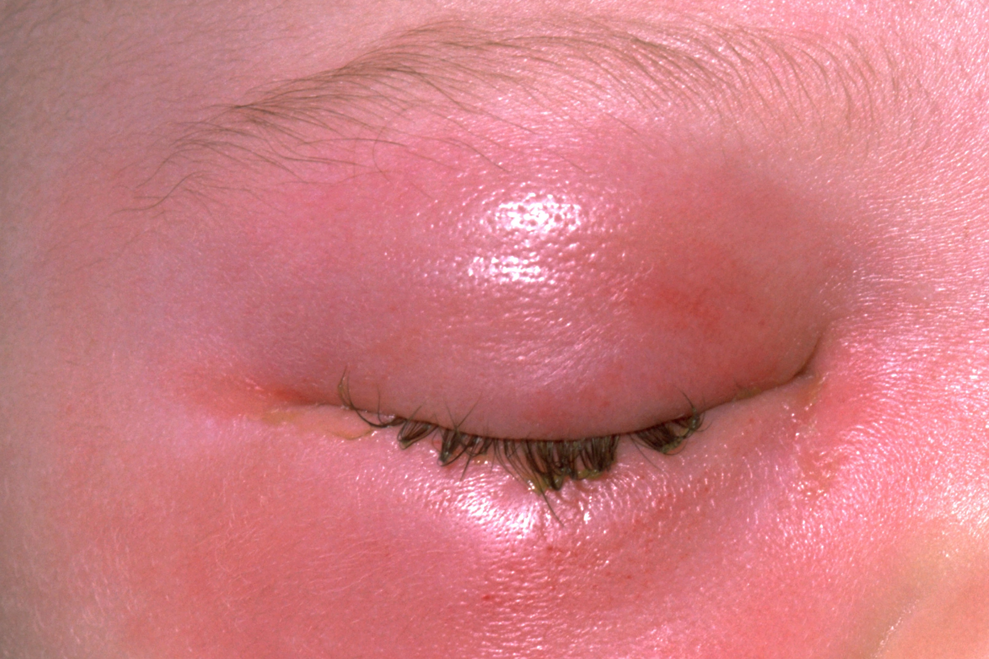 Illustration showing cellulitis.
