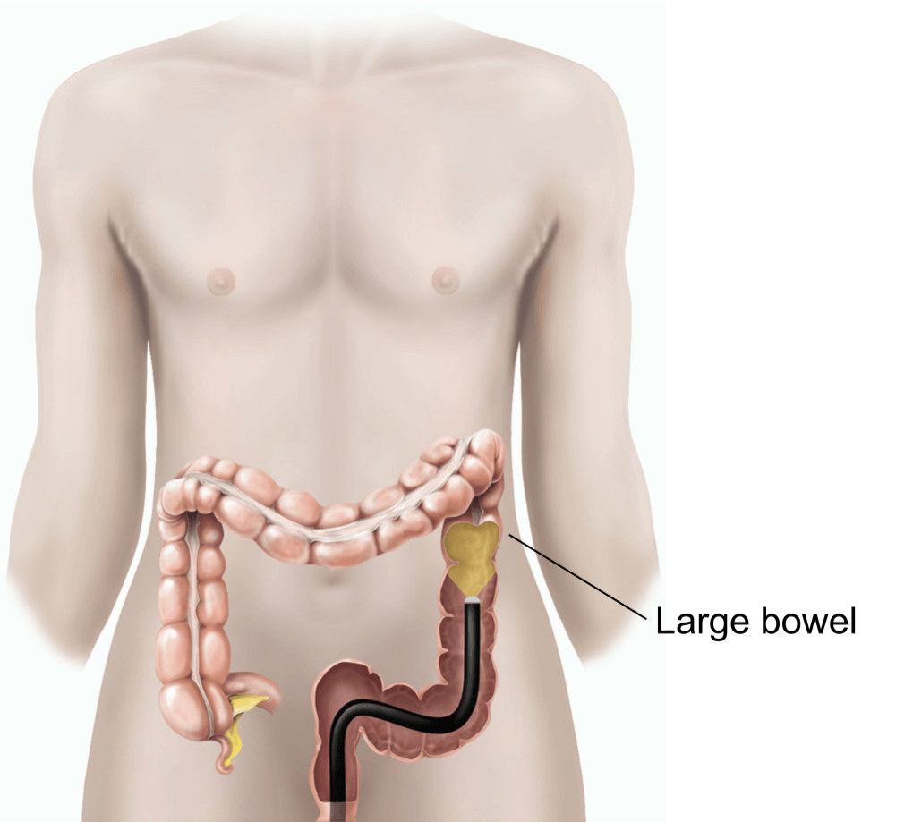 Illustration of a flexible sigmoidoscopy.