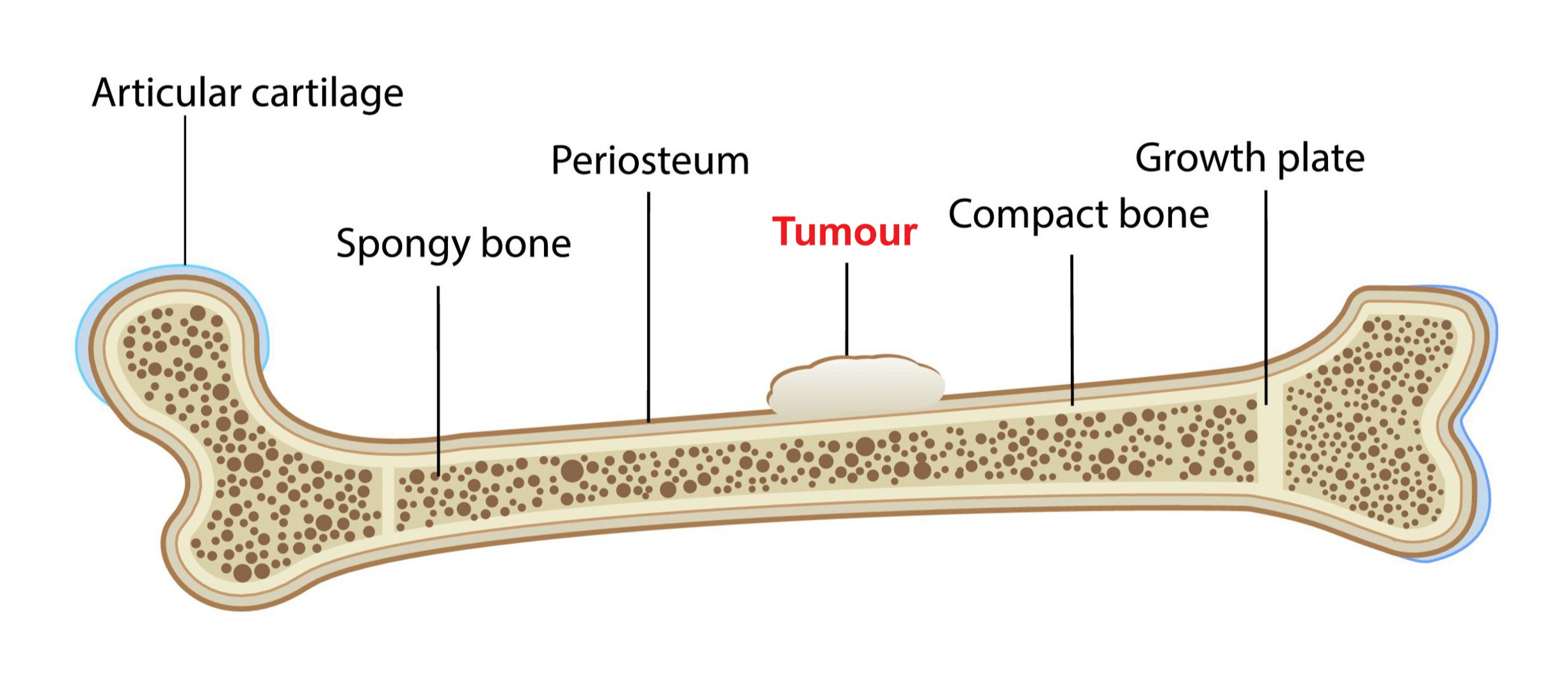 Illustration of primary bone cancer, which is sometimes called 'osteosarcoma' or 'bone sarcoma'.