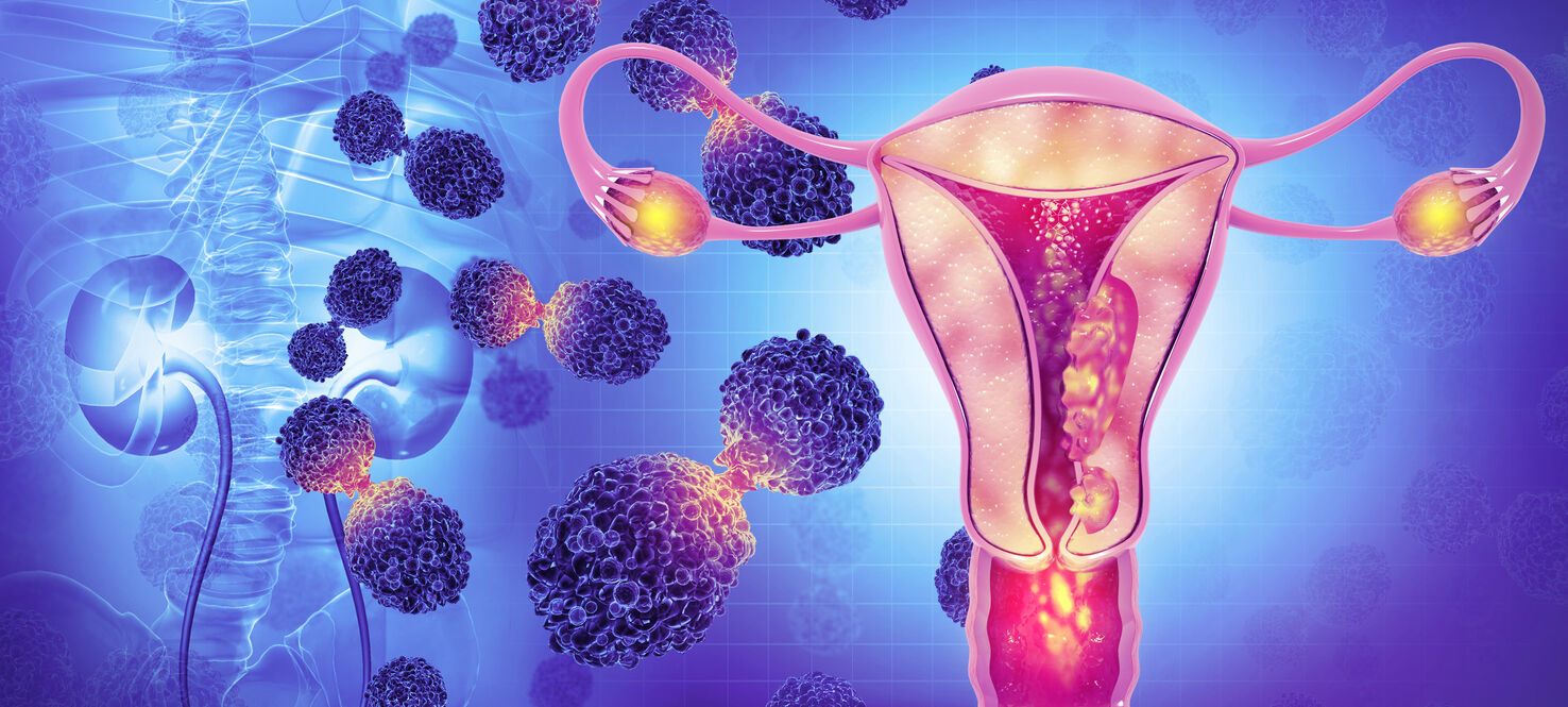 Female reproductive system diseases. Uterus cancer and endometrial malignant tumor as a uterine medical concept. 3d illustration