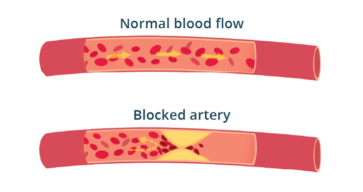 Illustration of a blocked artery