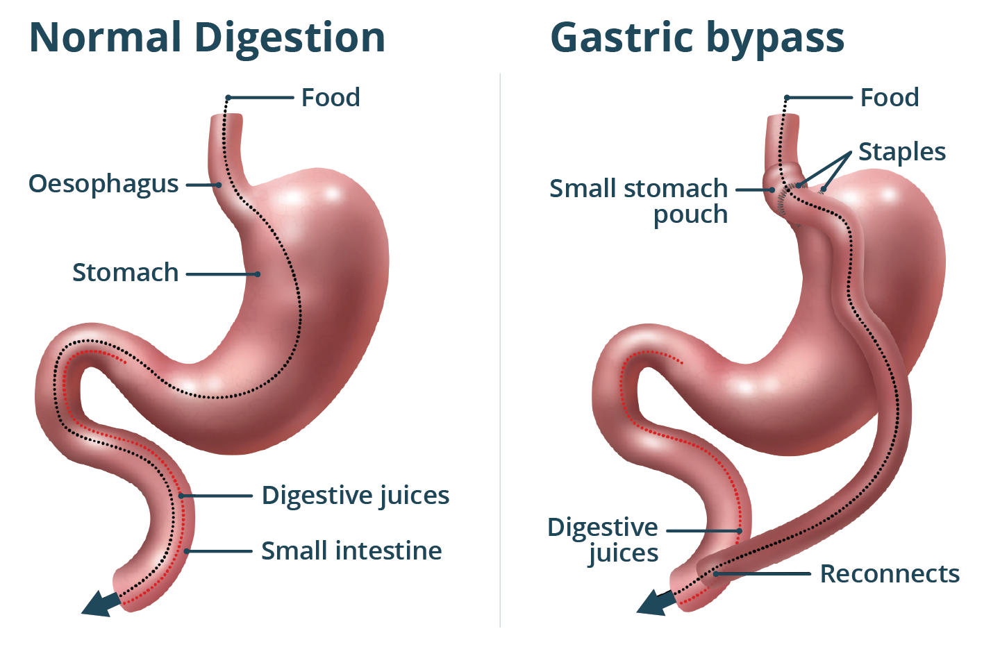 illustration of a gastric bypass