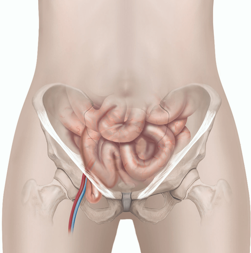 Illustration showing a femoral hernia.
