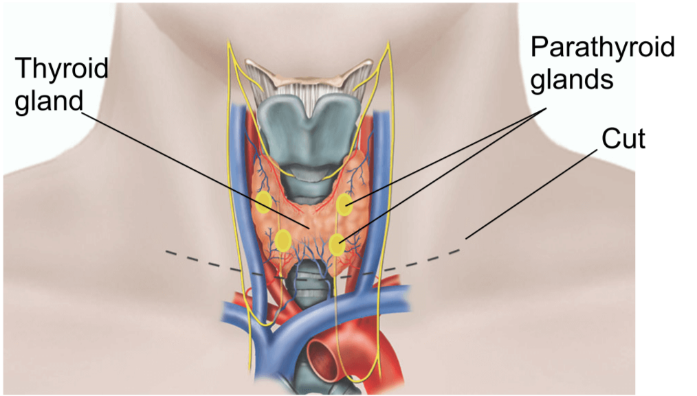 The thyroid gland, the parathyroid glands and a line showing where the cut will be
made.