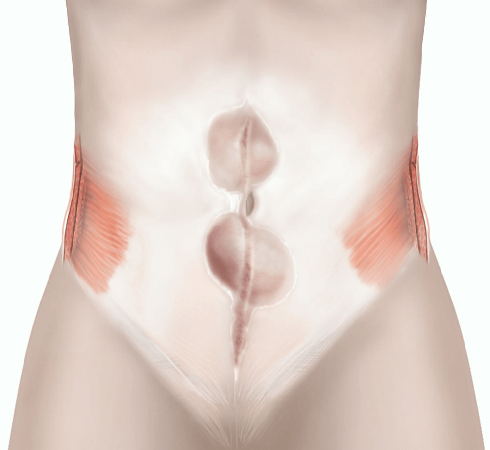 Illustration of an incisional hernia.