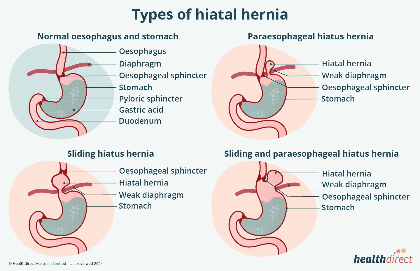 Illustration of the common types of hiatal hernia; sliding, parasophgeal and combined sliding a paraesophageal.