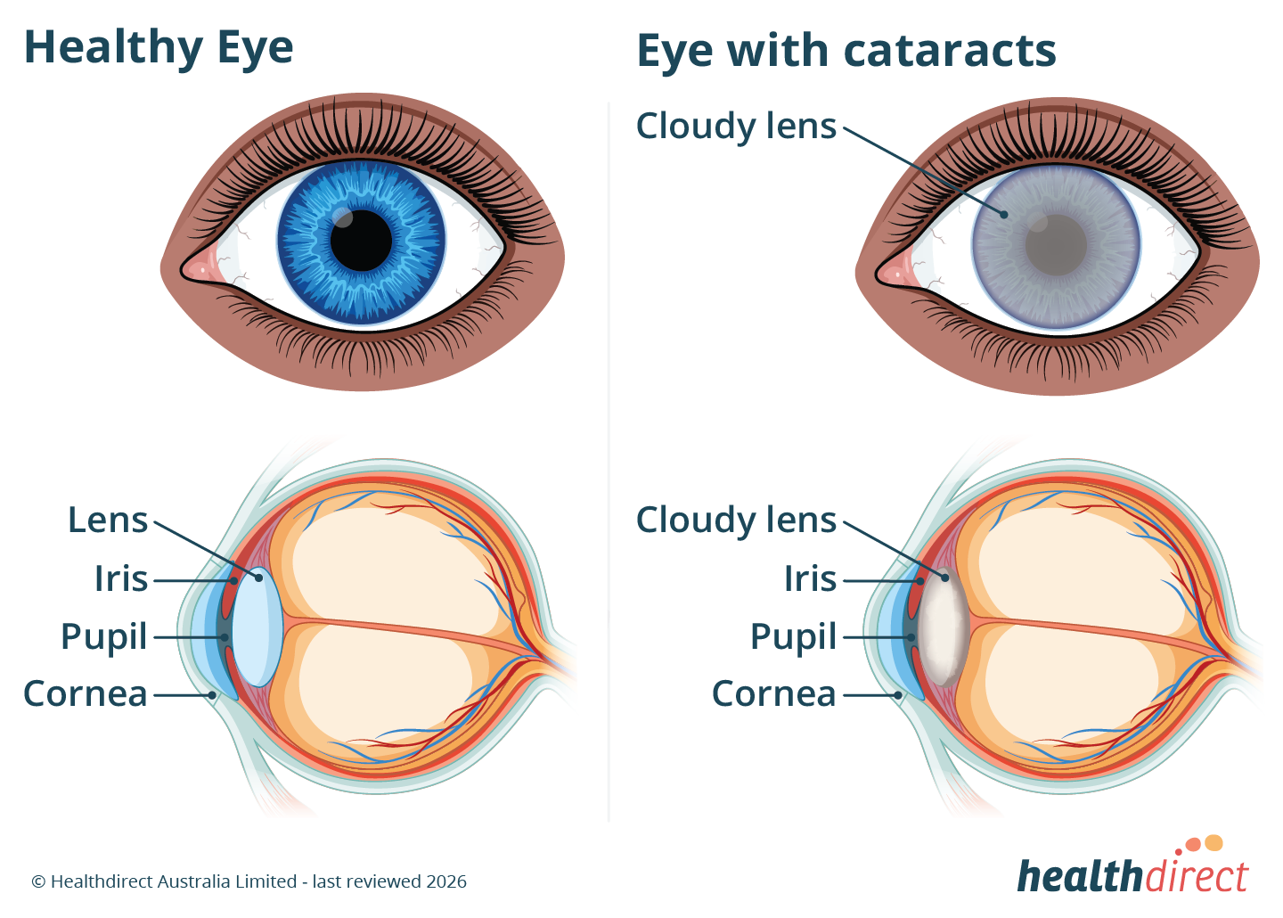 Illustration showing a healthy eye with a clear lens and an eye with cataracts and a cloudy lens.