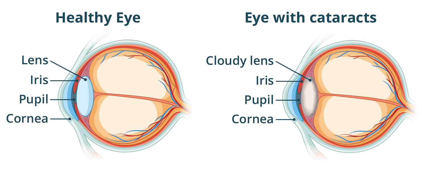 Diagram showing a healthy eye with lens and an eye with cataracts and a cloudy lens. Landscape view.