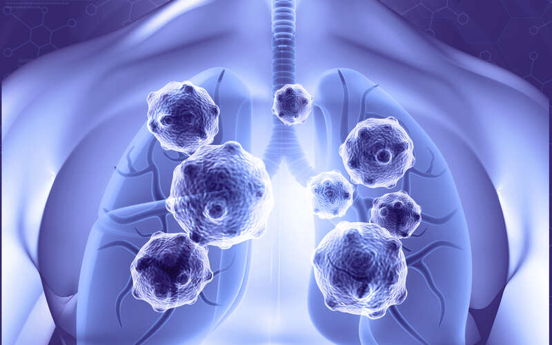 graphic image of a lung scan with exaggerated cancer cells in the lungs
