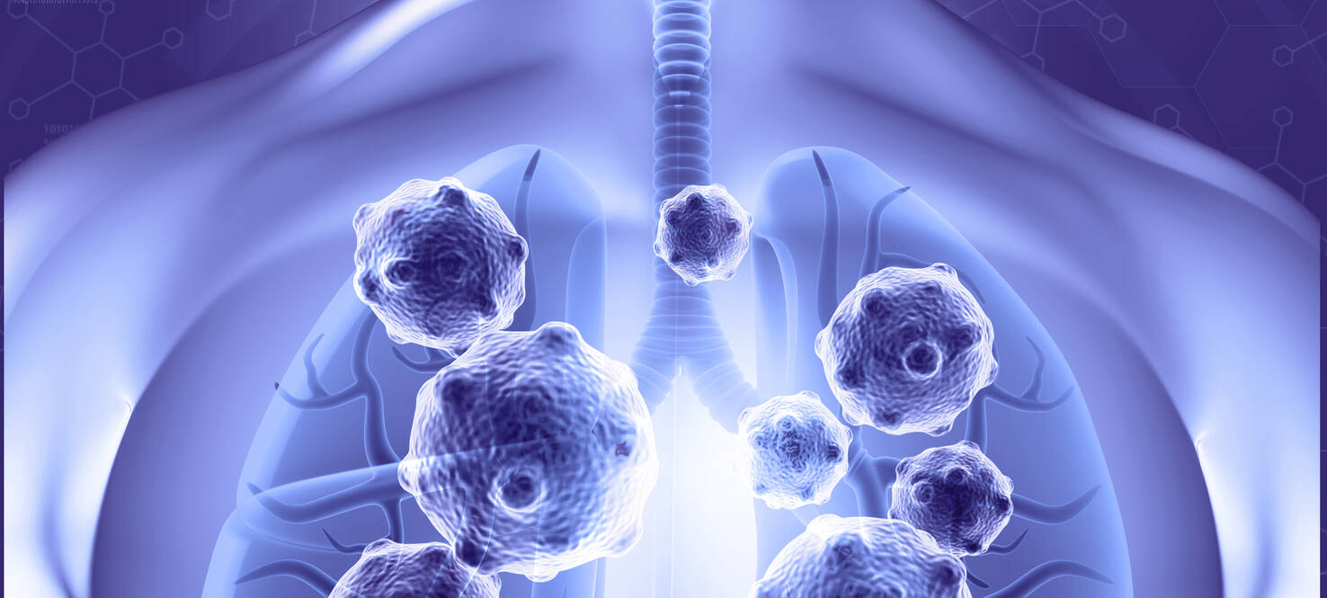 graphic image of a lung scan with exaggerated cancer cells in the lungs