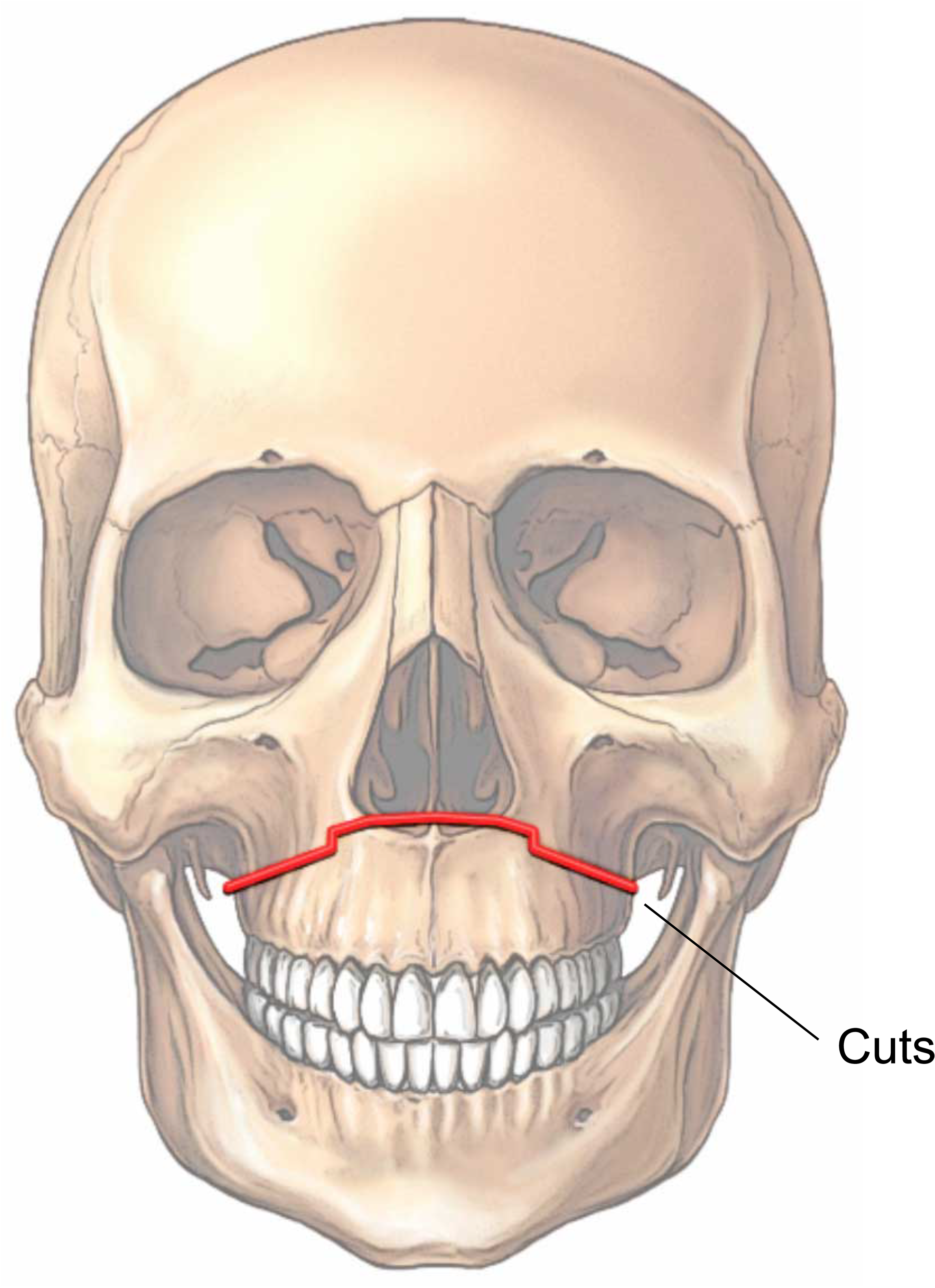 Illustration showing the cuts of a Le Fort 1 osteotomy.