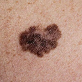 Melanoma file picture