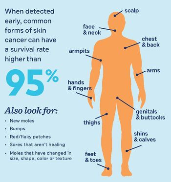 A graphic illustrating where to look for signs of skin cancer.