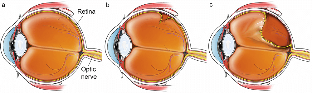 Illustration showing a normal, torn and detached retina.