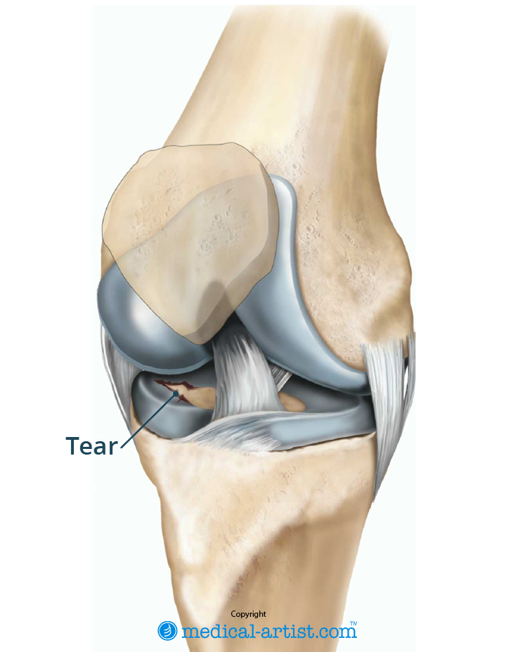 Illustration of a right knee with a tear in the lateral.