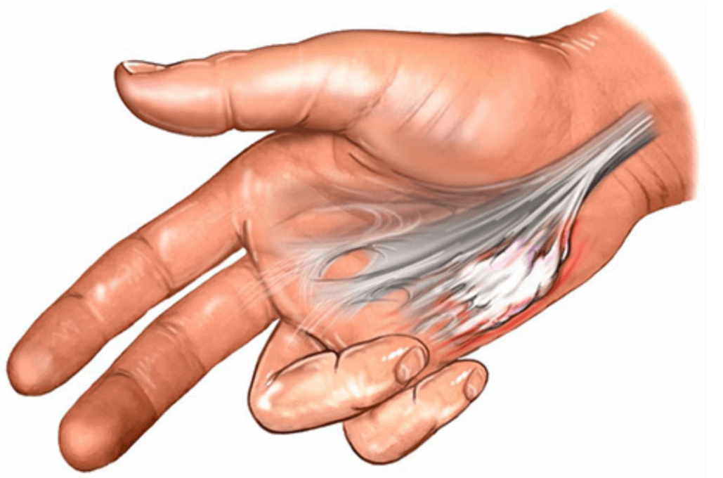 Illustration showing Dupuytren's contracture, where scar-like tissue in the palm under the ring and little fingers contracts and forces the fingers to curl into the palm.