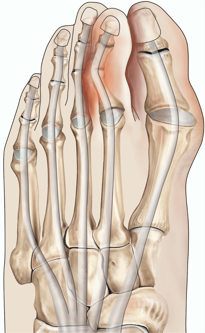 Illustration showing problems caused by a hammer toe.