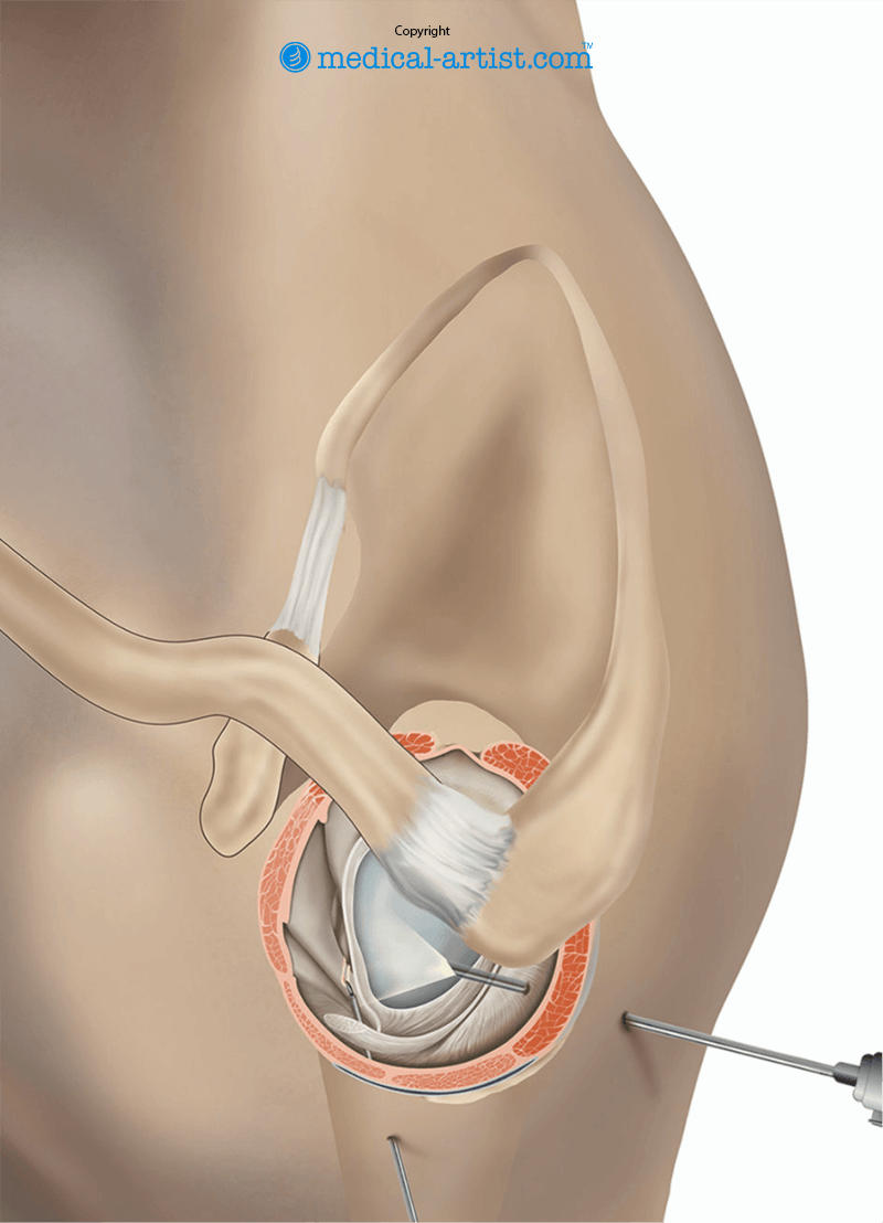 Illustration of an arthroscopy of the shoulder.