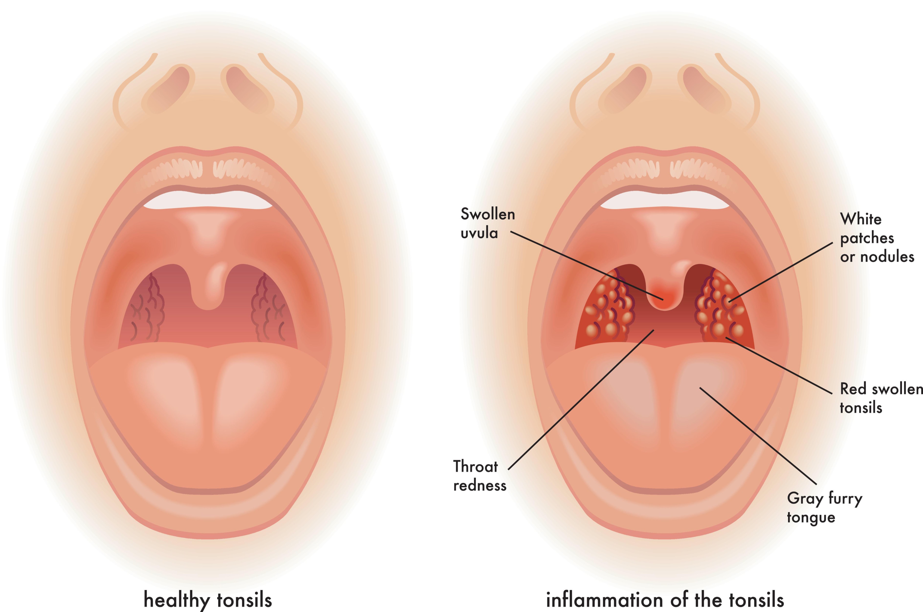 Comparison of healthy tonsils compared to inflamed tonsils.