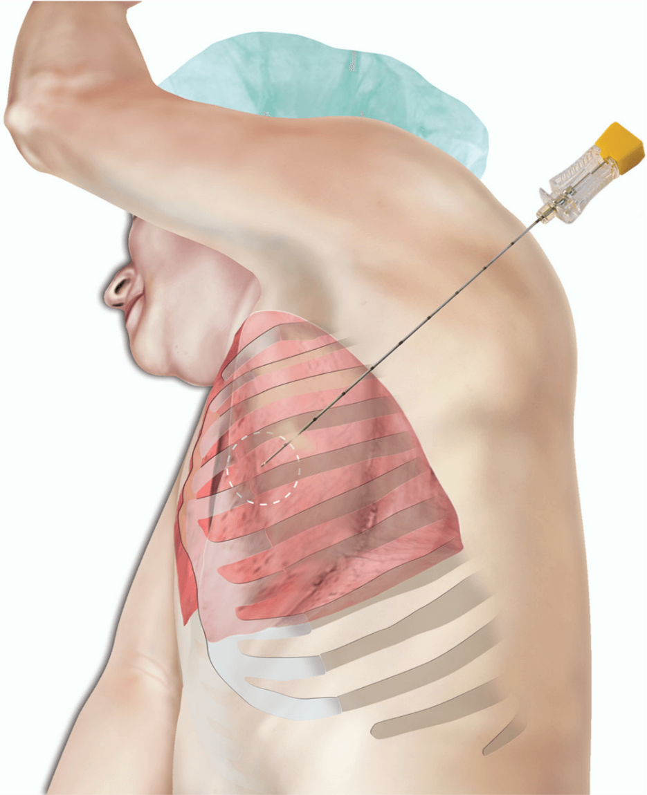 Illustration showing a lung biopsy.