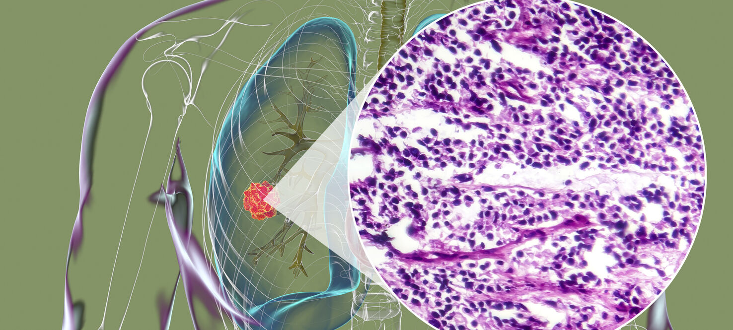 A human body with transparent skin showcasing lung cancer, 3D illustration complemented by a light micrograph of the small cell lung cancer.